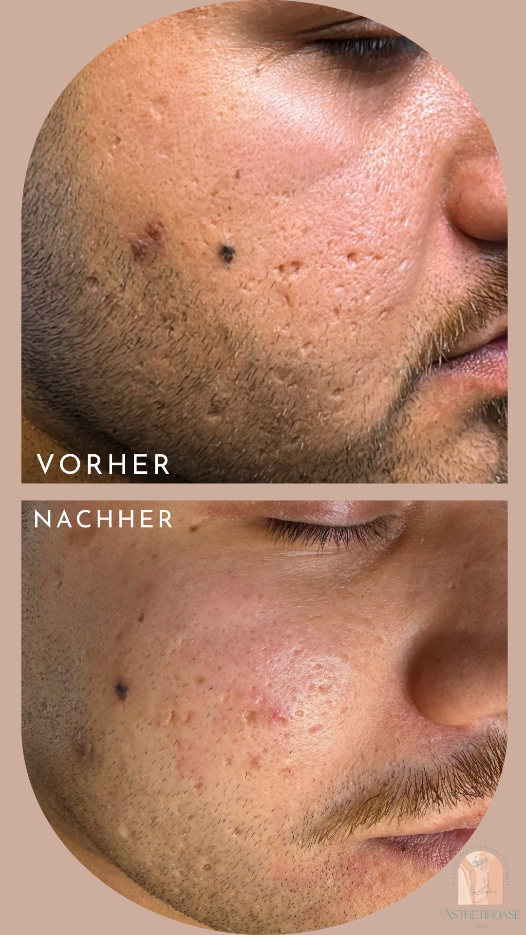 Akne-Behandlung — Vorher und Nachher, echter Kunde der Ästhetikoase